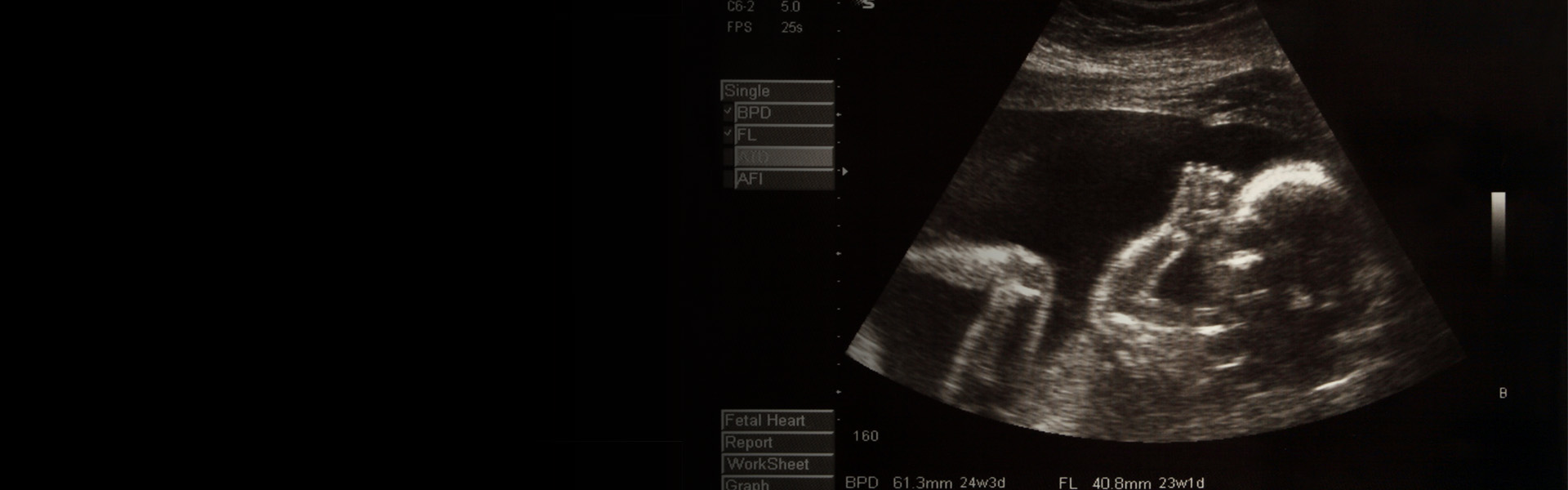 An ultrasound of a baby